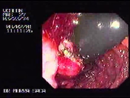 Familial Adenomatous Polyposis of the Colon (9 of 29)