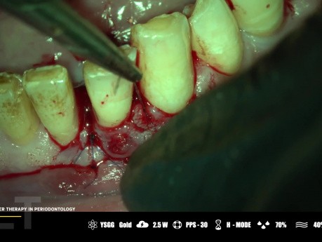 Microsurgical Laser Therapy in Periodontology