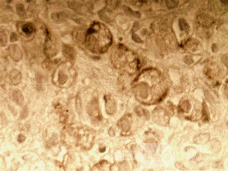 Endoscopy of Scirrhous Gastric Carcinoma involving the entire Fundus, Body and the Antrum (8 of 47)