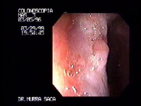 Histoplasmosis of the Colon (1 of 3)