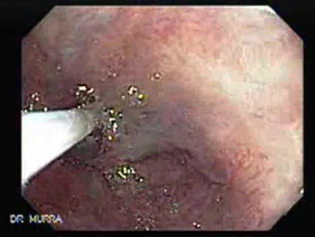 Ligation of Esophageal Varices -  Sclerotherapy