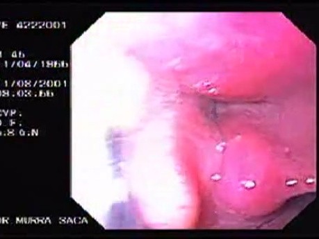 Oropharinx of a professional singer (1 of 2)