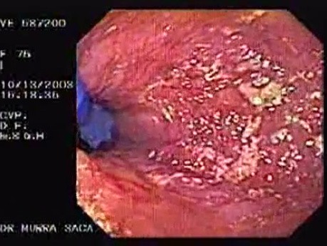 Esophageal Achalasia (12 of 16)