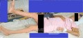 Spinal cord injury from spearfishing harpoon