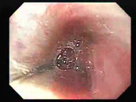 Achalasia Residual Food (3 of 11)
