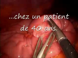 Invaginated Meckel Diverticulum In Laparoscopic View
