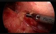 Laparoscopic Left Adrenalectomy