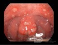 Throat Ulcers