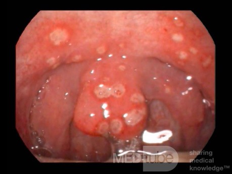 Throat Ulcers