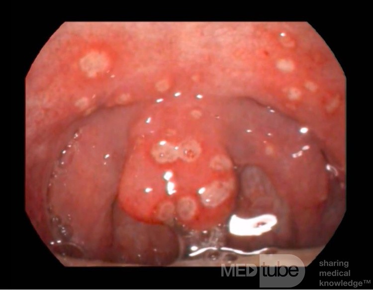 Throat Ulcers