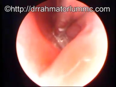 An Office Procedure of Removal a Foreign Body from The Nose