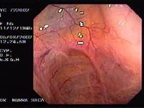 Prominent Mucosal Scarring