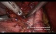 Tips and tricks. Pelvic Lymphadectomy.