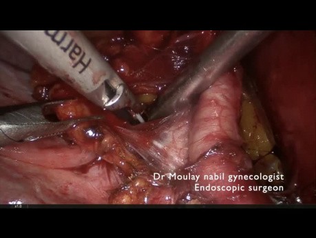 Tips and tricks. Pelvic Lymphadectomy.