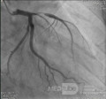Coronary Angiogram Showing Proximal LAD Lesion with Thrombus