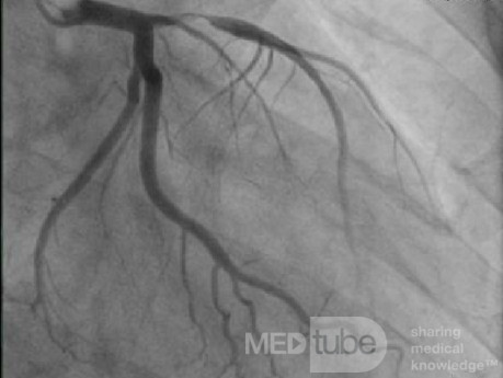 Coronary Angiogram Showing Proximal LAD Lesion with Thrombus