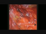 Uniportal VATS Right Upper Lobectomy • Video • MEDtube.net