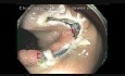 Ileocecal Valve Flat Lesion - Details: Injection and Resection