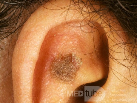 Seborrheic Keratosis