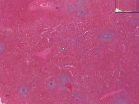 Hereditary spherocytosis