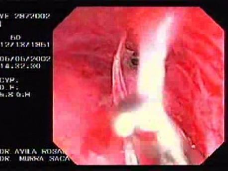 Zollinger- Ellison Syndrome - Gastric Ulcer with Gastrocolic Fistula (11 of 21)