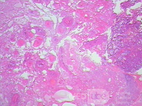Endoscopic Resection of Giant Tubulo-Villous of the rectum (25 of 35)