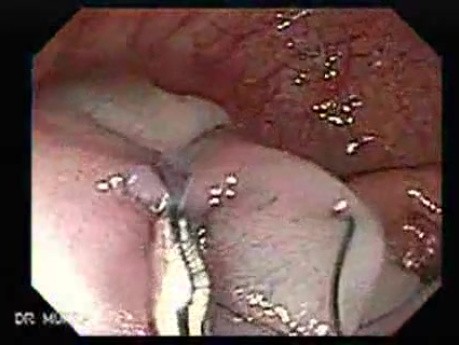 Colonoscopic Polypectomy (13 of 23)