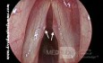 Bilateral Vocal Fold Polyps Due to Repetitive Phonotrauma