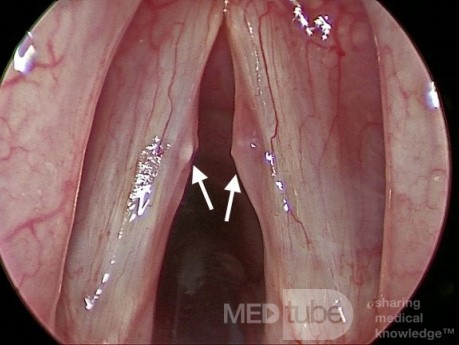 Bilateral Vocal Fold Polyps Due to Repetitive Phonotrauma