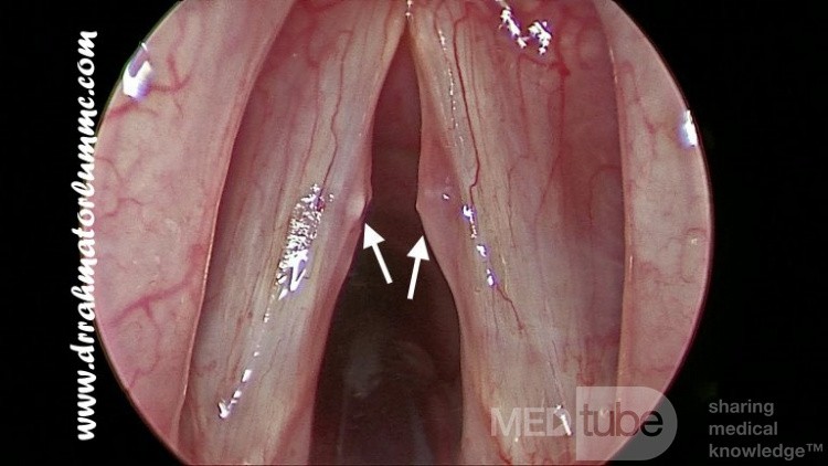 Bilateral Vocal Fold Polyps Due to Repetitive Phonotrauma