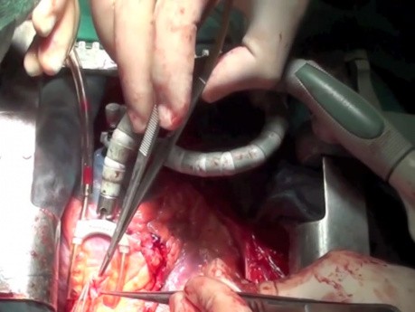 OPCAB - Off Pump Coronary Artery Bypass Grafting - Male Patient