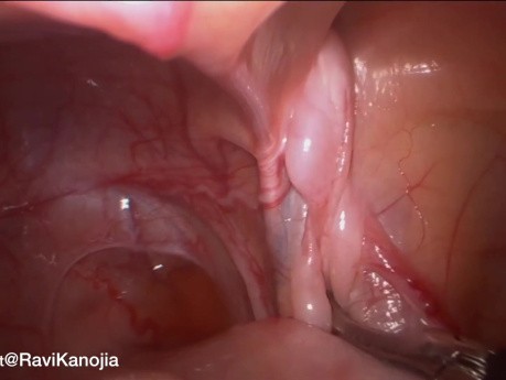 Laparoscopic Case Scenarios in Non Palpable Undescended Testis