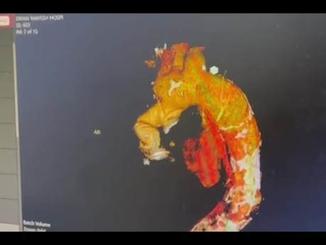 Redo Aortic root Surgery in Two Antegrade and Retrograde Technique