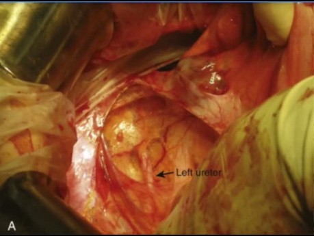 Extended Right Hemicolectomy and Left Hemicolectomy for Colorectal Cancers