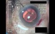 Cataract Surgery IV - Part 4