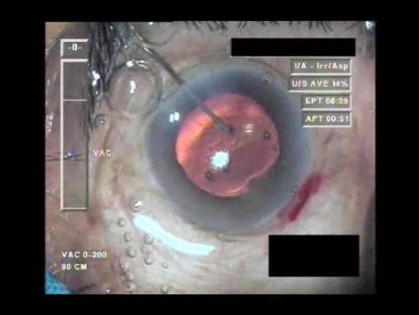 Cataract Surgery IV - Part 4