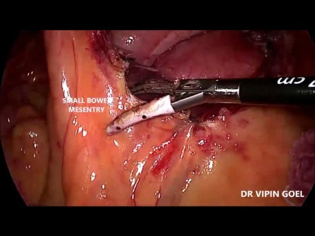 Laparoscopic Right Radical Hemicolectomy With Complete Mesocolic Excision
