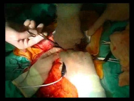 Open Right Hemicolectomy – Technical Principles - Operation No 2 - Part 2