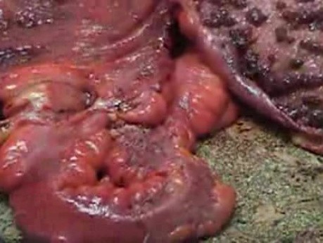 Multiple Rectal Ulcers (67 of 110)