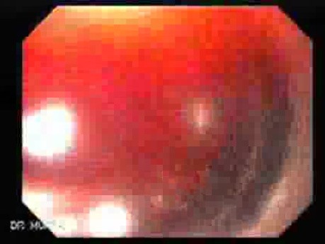 Duodenal Ulcer and Bleeding (10 of 23)