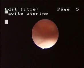 Normal Hysteroscopic Aspect Of Uterine Cavity