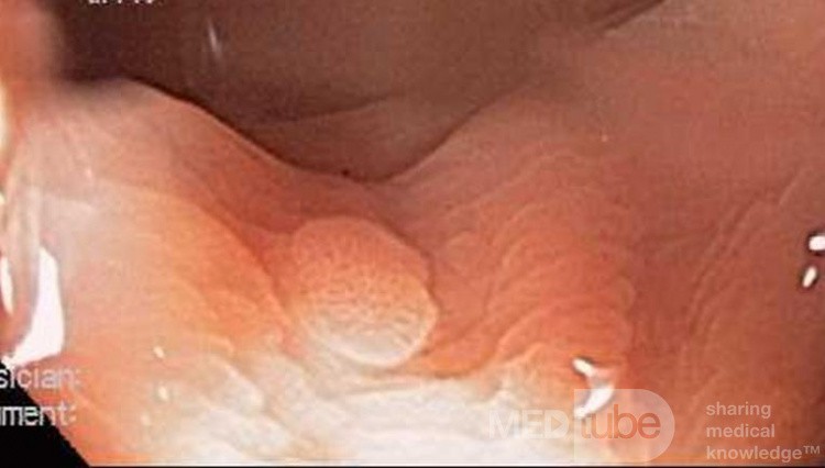 Hyperplastic polyp with lymphoid follicle