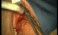Rebuild Of Madnibular Implant Site (4/4)