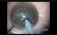 Oval rhexis in a case of posterior polar cataract with pre existing rent