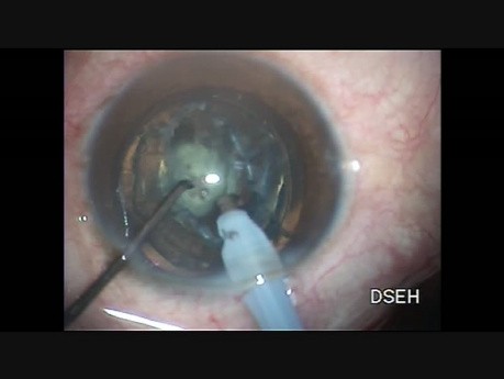Oval rhexis in a case of posterior polar cataract with pre existing rent