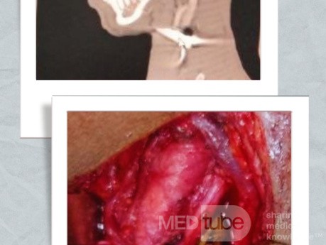 Gunshot wound with entry site in the right mandibular region