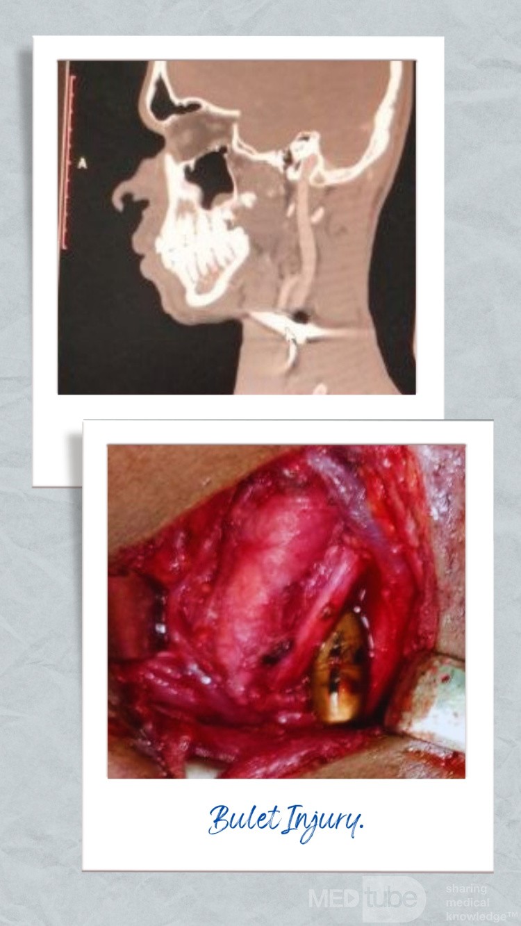 Gunshot wound with entry site in the right mandibular region