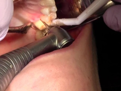 How To Lenghten Clinical Crown? (#14)