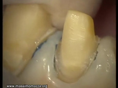Upper Arch Teeth Preparation And Provisional Crowns (4/5)