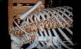 Multiple Ribs Fracture